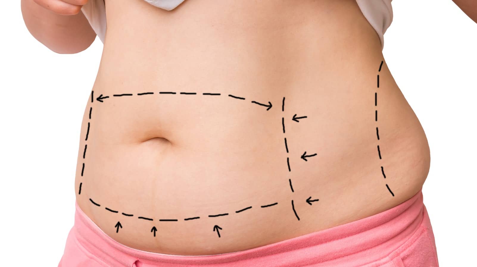 tummy tuck surgery cost in india
